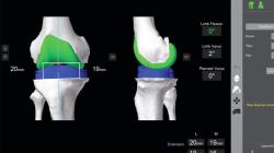 Photo: Knee Replacement by Dr. Mark Gesell